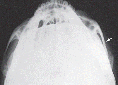 Posicionamiento arcos cigomáticos